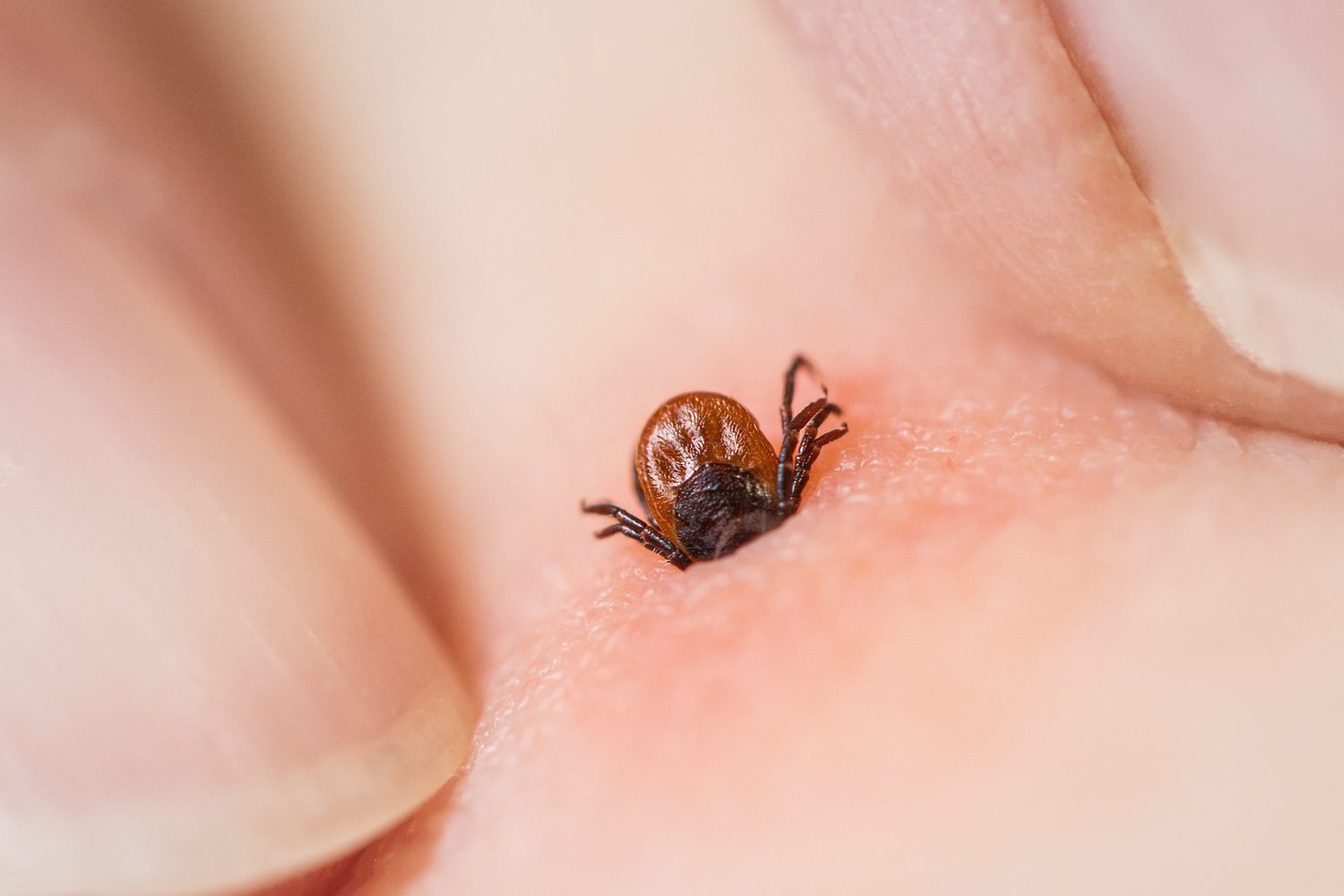 Fingers and Fingernails Squeeze a Tick and Tick Bite with Inflammation And Irritation Of The Human Skin